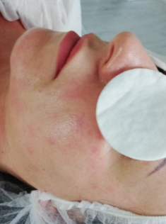 biorewitalizacja